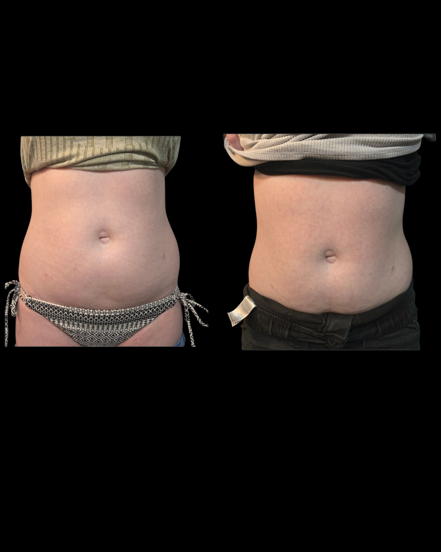 Emsculpt NEO Results 12